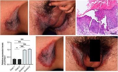 Case report: Difference in outcomes between two cases of Hailey-Hailey disease treated with apremilast